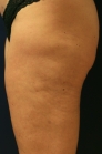 Feel Beautiful - Thigh Cellulite Thermi-RF treatment - Before Photo